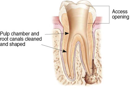 Bacteria in tooth needing root canal.