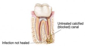Bacteria in tooth needing root canal.
